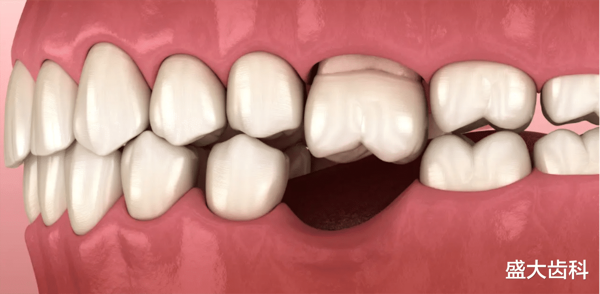 牙齿|镶牙疼不疼?