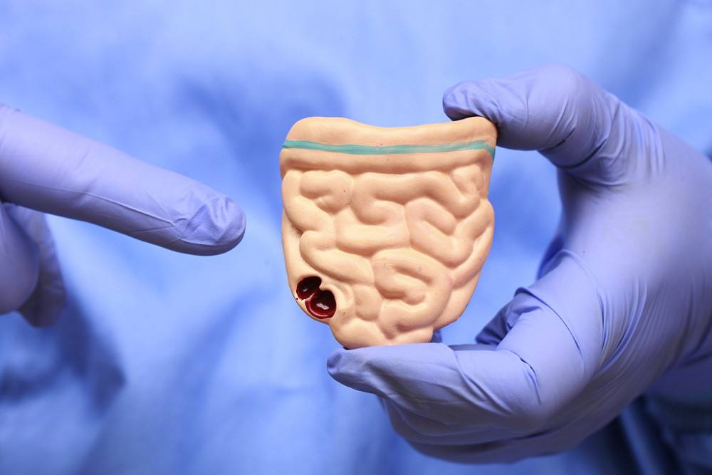 肠癌|肠癌的饮食禁忌有哪些?