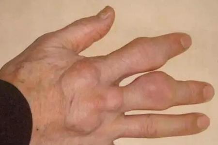 咳嗽|不管烟瘾有多大,身上2处“凸起”, 请戒烟,可能肺“撑”不住了