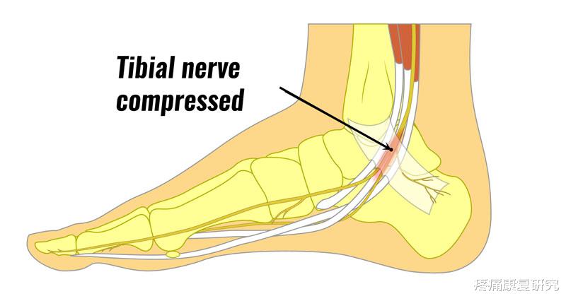 妇科病|【汇总】导致足跟痛的原因