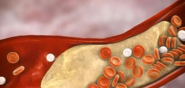 卵巢癌|高血脂人群:猪蹄、鸡蛋和牛奶,哪一个能吃?医生告诉你答案