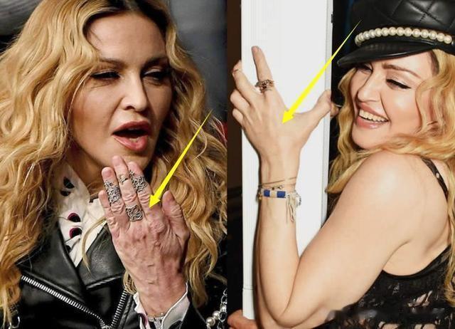 麦当娜|64岁麦当娜承认整容:术后消肿了,看我多可爱