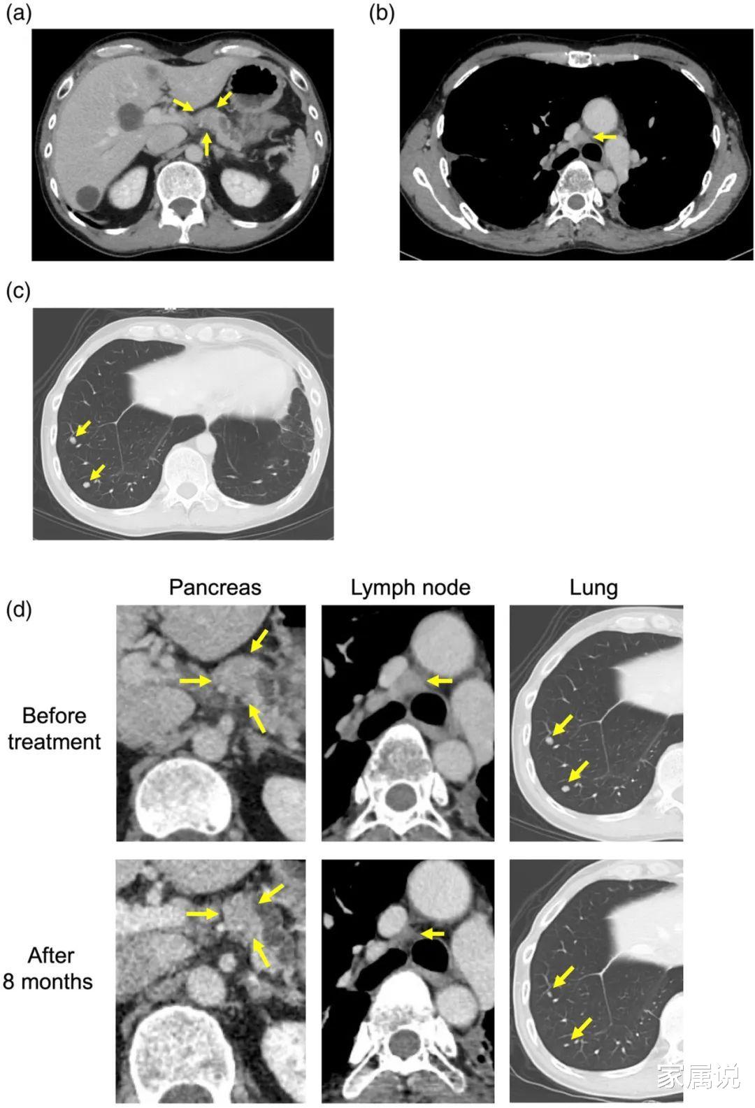 运动|「案例」罕见突变肺癌患者竟奇迹存活超20年!抗癌经验值得借鉴!
