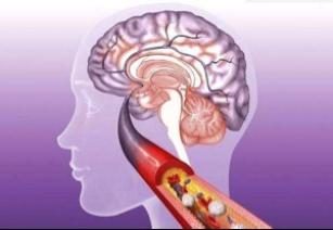 脑梗塞|为何“脑梗”越来越多?少碰4类食物,多吃它,血管通畅了