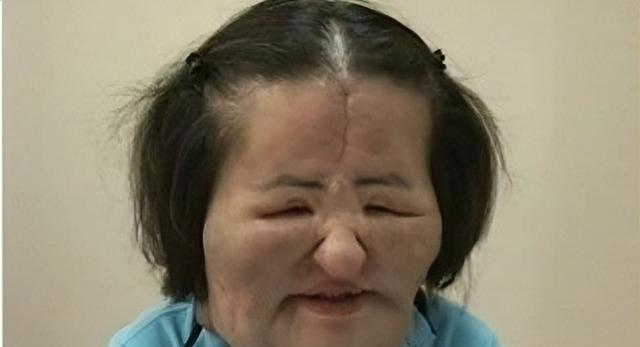 整形|韩国妹子先后做17次手术,取出260克异物,把脸整容成“电风扇”
