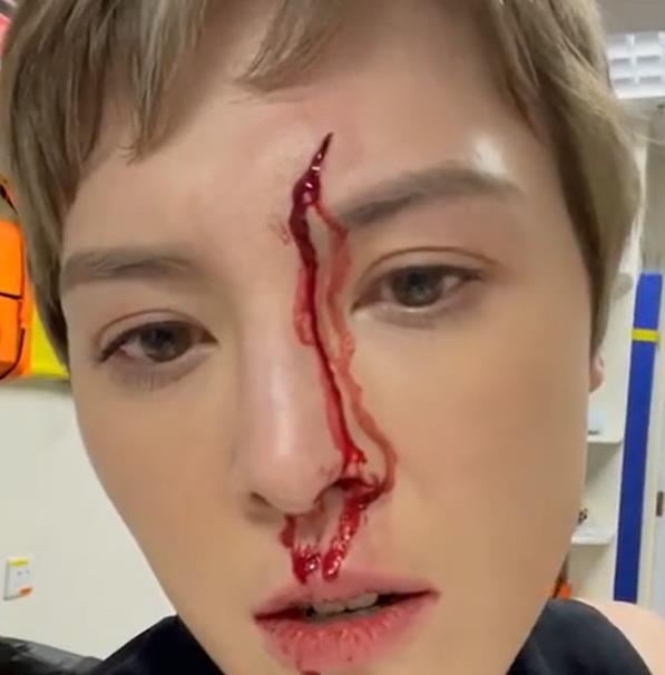 |女星何慈茵录节目意外受伤，额头撞上玻璃皮肤流血，被送医院缝针