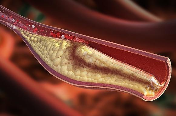 牛奶血|25岁女子血液变“牛奶”,得知原因后悔大哭,“这事”可能做太多