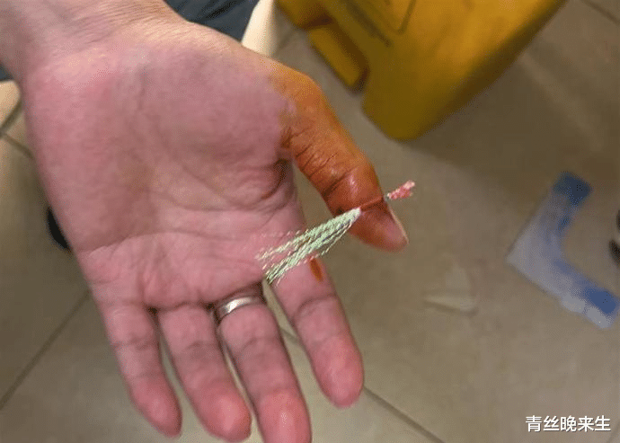 范振钰|资深钓友钓起“水老虎”，却不慎被鱼钩钩穿拇指