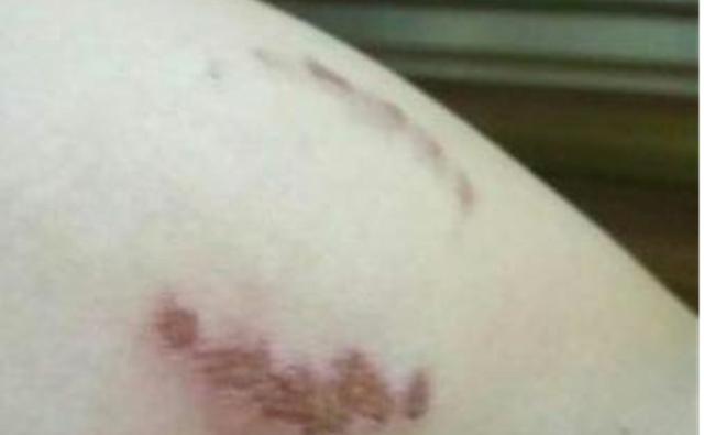 案例：留守少妇畸恋男技师，因丈夫发现其臀部有咬痕酿悲剧
