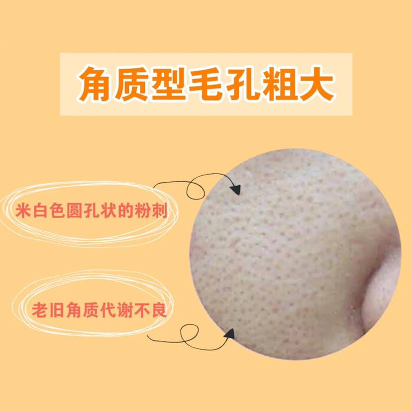 粉刺 女生毛孔粗大真的没救了吗？