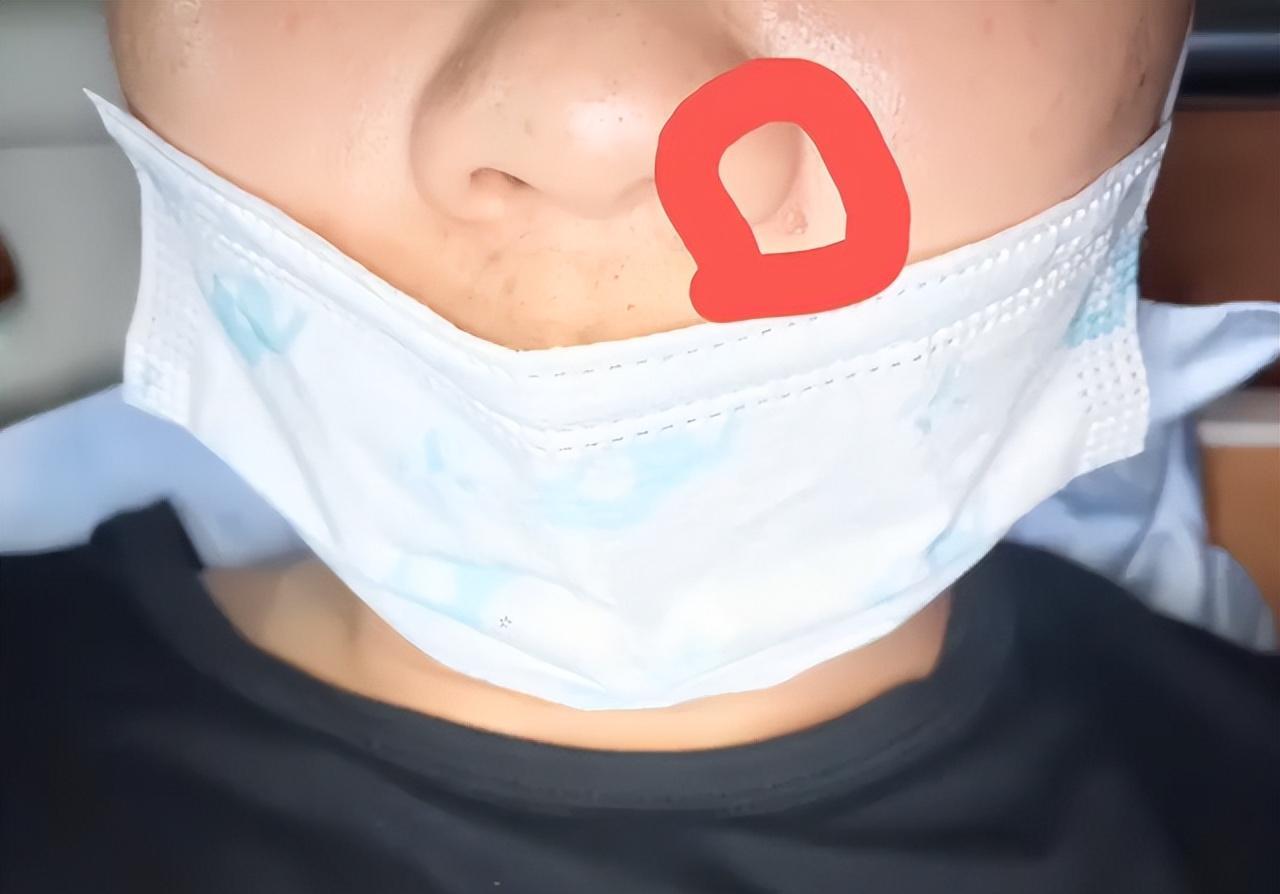 广西南宁:男子挤了一颗痘后,被医生下“病重通知书”