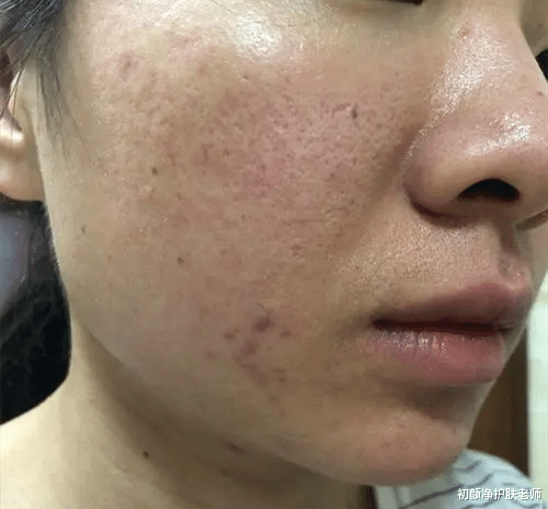 保湿 皮肤屏障修复的真相：不是疯狂保湿修复！