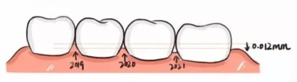 牙齿|如果你发现你的牙齿有黑三角,那么就要去看牙科医生了!