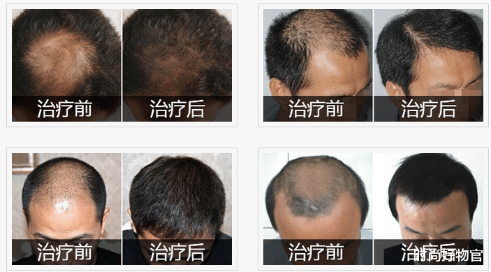 洗发水 阿道夫、潘婷“无人过问”，李佳琦力荐的国货洗发水火了，控油去屑防掉发