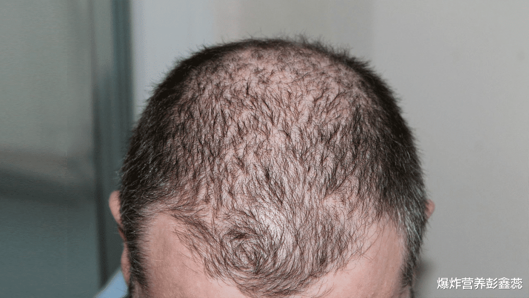 脱发|长期不用洗头发水,就可以长出更多的新发?脱发的人怎样做长头发