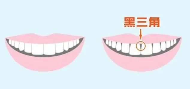 牙齿|如果你发现你的牙齿有黑三角,那么就要去看牙科医生了!
