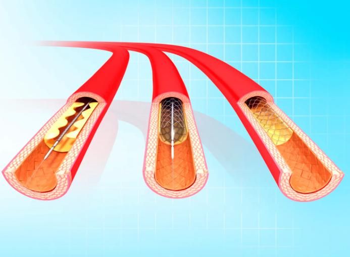 柿子|心梗后放置心脏支架,还能多活几年?这一次医生说了大实话