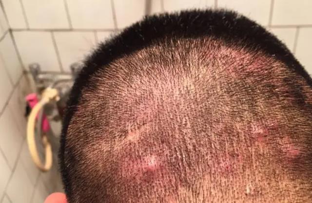 芡实|头皮总是长“疙瘩”和“脓包”,是咋回事?或是这3方面的原因