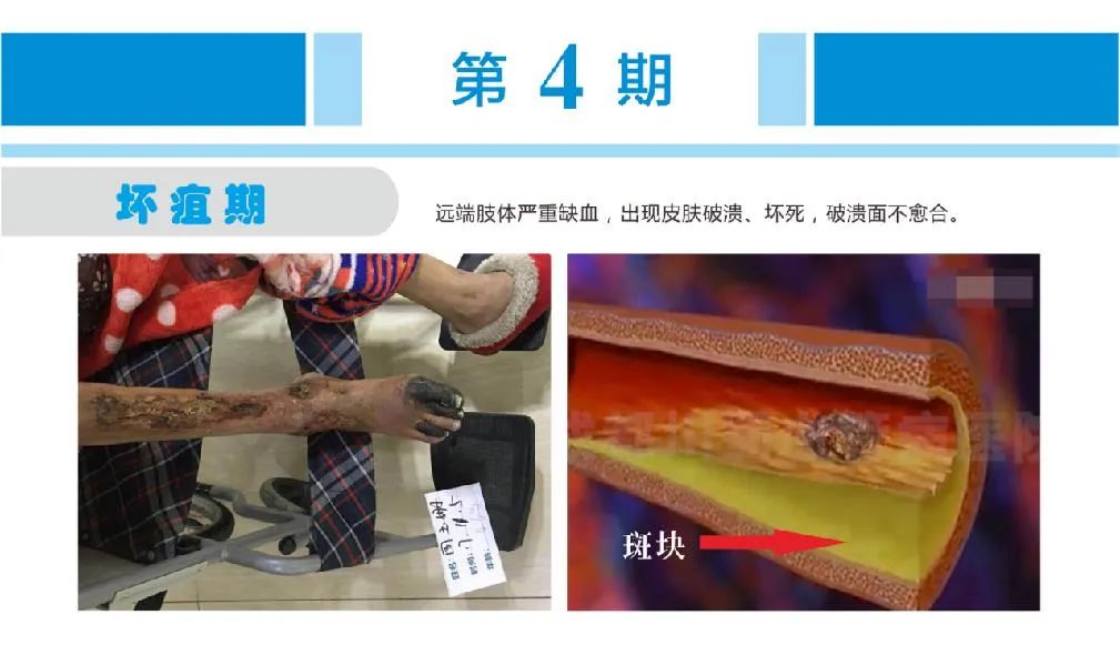 动脉硬化|血脂检查的意义是什么?川蜀专家教你防治动脉硬化~