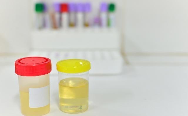 水果|男人晨起上厕所,身体若有3“感觉”,别大意,可能是肾衰竭前兆