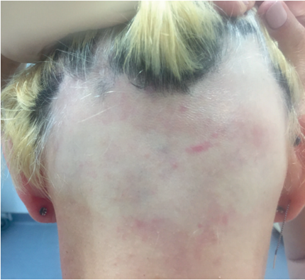 脱发|再生率高达80%！干细胞改善脱发促进毛囊再生