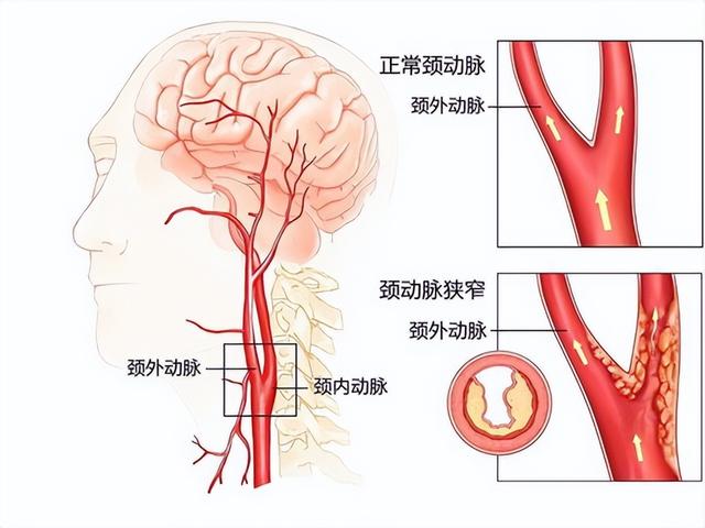 体检|体检查出的颈动脉斑块能够变小甚至是消失吗