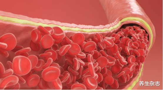 脑梗|血液干净的人,一般会有3个特征,若你全占,血管健康脑梗不敢来扰