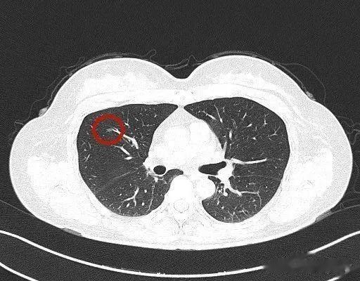 高血压|肺结节怎么切是否一定要听医生的？患方自己参与决策讨论更有益！