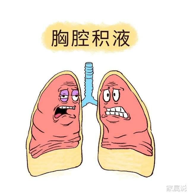 肺癌|恶性胸腔积液是癌症已经扩散的迹象吗？胸腔积液反复怎么办？