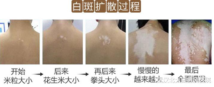 白癜风|夏季白癜风易扩散，患者该怎么吃？这里有饮食清单！