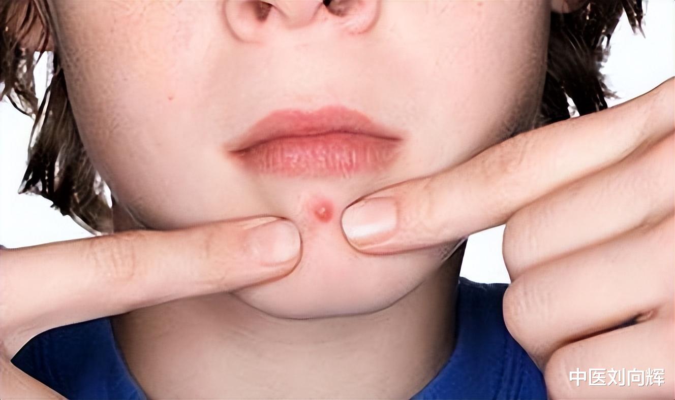 甲沟炎|上火,还怕冷?只需一味药,帮你打通中焦,将你的火气化为元气