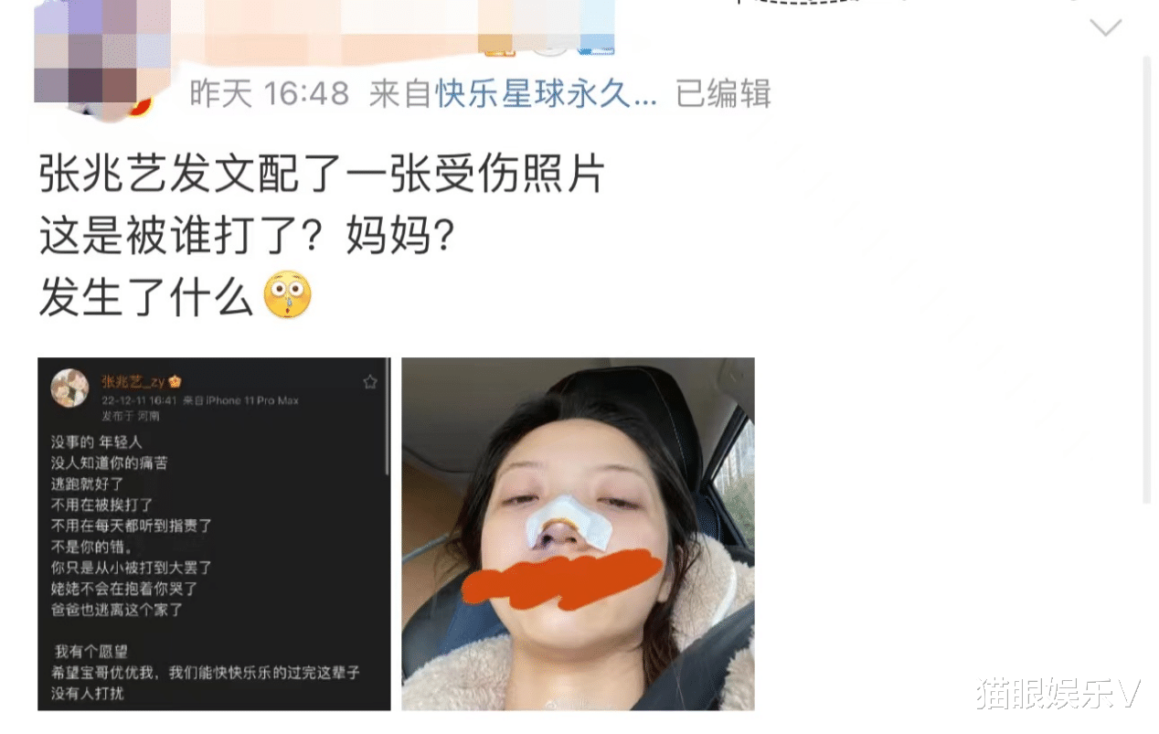张兆艺|演员张兆艺晒受伤照片,自曝惨遭妈妈家暴,鼻子受伤裹纱眼眶含泪