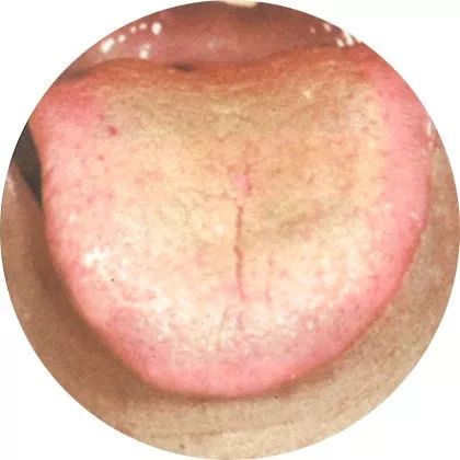 失眠|中医中的舌诊,了解吗