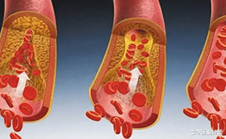 血糖|“升糖大户”被揪出,吃一口如吃十斤砂糖,劝告父母:“1黄”尽早戒