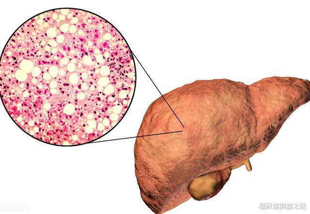 糖尿病|为什么脂肪肝也要改善肠道菌群？最新研究发现膳食纤维改善脂肪肝