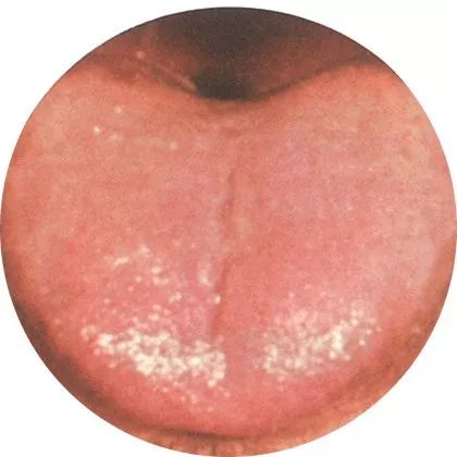 失眠|中医中的舌诊,了解吗