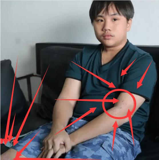 小小彬|小小彬正当红时赚1800万,长残后无戏可拍,如今得病皮肤溃烂