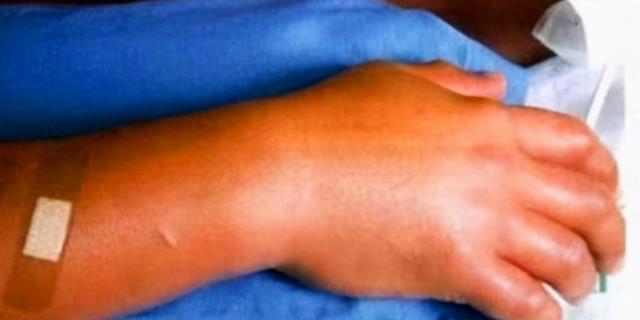 肌肉溶解、化成血水,徒手掰开原子弹后,成了等待死亡的活死人