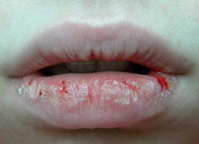 美容|有妇科病的女人，嘴巴可能有这四种现象，希望你一个都不占