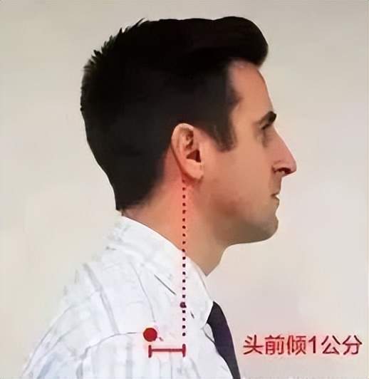 颈椎病|颈椎曲度变直？拿什么拯救你，我的颈椎？