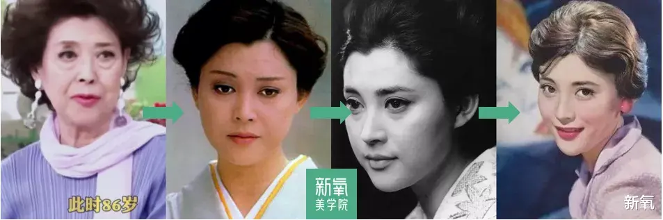 玻尿酸 她们对于“高平整度”的执念好深