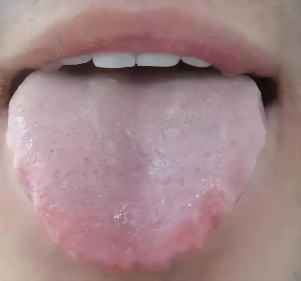 运动|一个方子三味药，用它煮水喝，可祛一身湿，从头到脚，改善齿痕舌