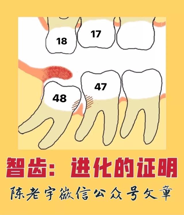 医生|智齿:进化的证明