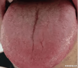 针灸|舌头有很多裂纹怎么办?三种舌象,快来对照你是哪一种?