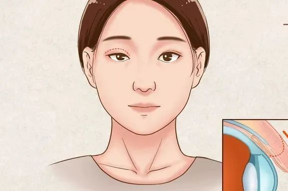 上睑下垂|眼皮下垂?睁不开眼睛?这个病总是被误解