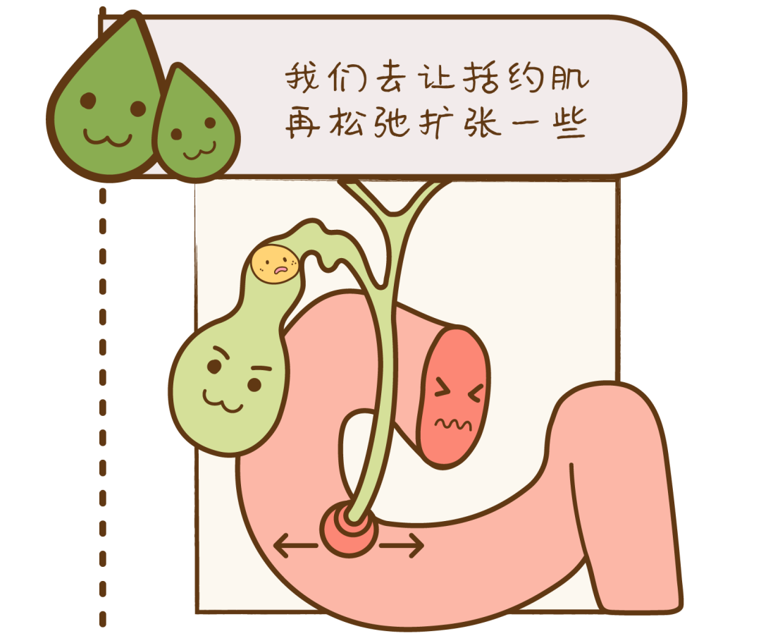 心脏病|胆结石是如何排出体外的?会划破胆管吗?