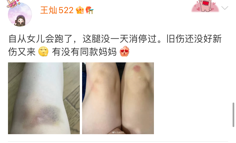 王灿|王灿一岁女儿好调皮，频繁跑步导致膝盖受伤，母亲晒照满是心疼