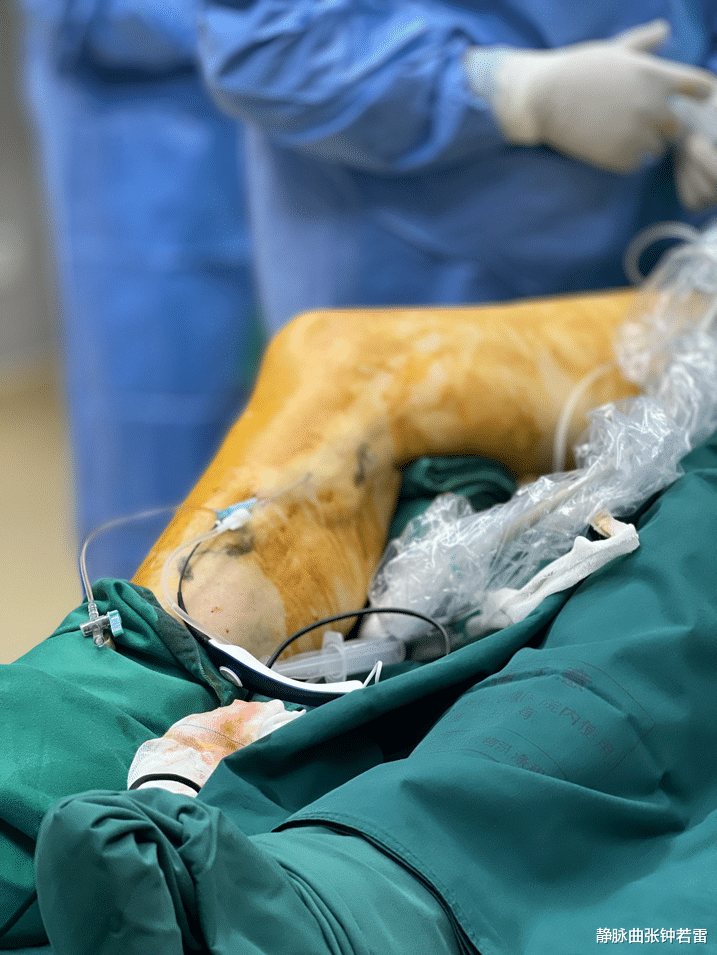 静脉曲张|炸筋腿怎么办|一线城市高管,“光鲜亮丽”背后,却因静脉曲张“苦不堪言”