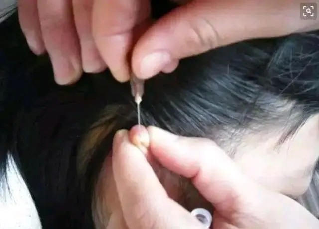 咳嗽|中医刺血泰斗王秀珍,终生致力于“王氏刺血疗法”,治愈患者无数