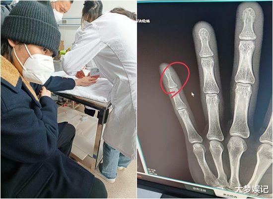 萧敬腾|萧敬腾传“骨头整根裂开移位”急送医!一照X光GG了,伤照曝光